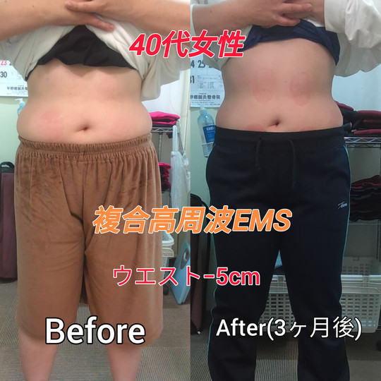 複合高周波EMS（Eトレ）効果実例
